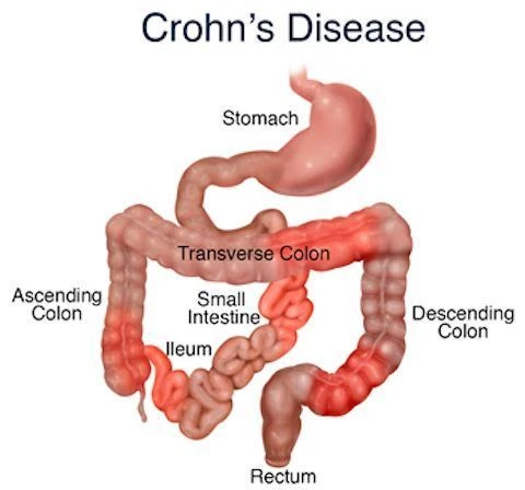 crohns disease crohns disease